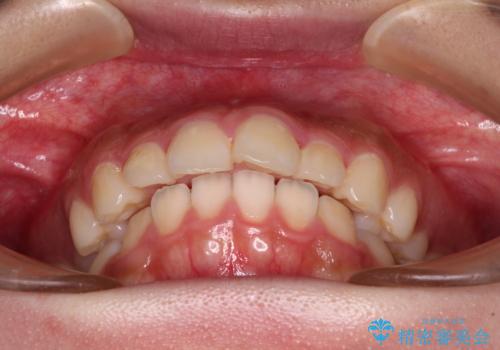 骨格的な出っ歯を抜歯矯正で改善 横顔の印象が劇的に変化の治療前