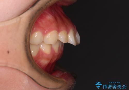 骨格的な出っ歯を抜歯矯正で改善 横顔の印象が劇的に変化の治療前