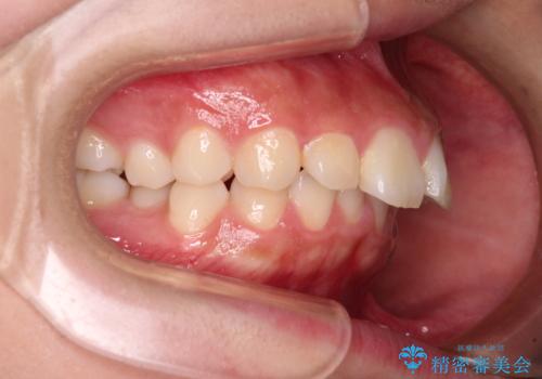 骨格的な出っ歯を抜歯矯正で改善 横顔の印象が劇的に変化の治療前