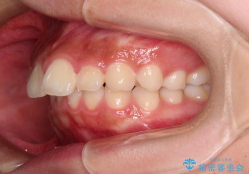 骨格的な出っ歯を抜歯矯正で改善 横顔の印象が劇的に変化の治療前