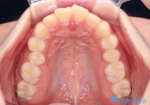 骨格的な出っ歯を抜歯矯正で改善 横顔の印象が劇的に変化の治療前