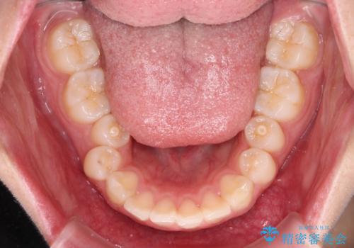 骨格的な出っ歯を抜歯矯正で改善 横顔の印象が劇的に変化の治療前