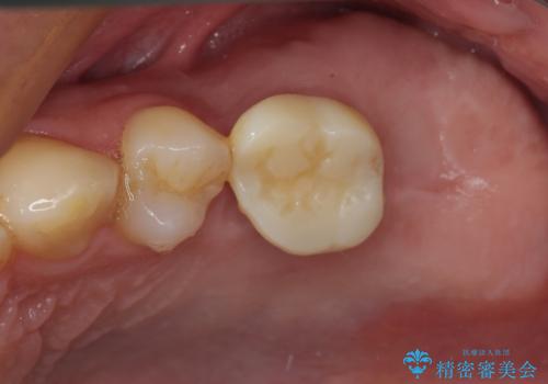 奥歯のむし歯が気になる 根管治療とインプラント治療の治療前