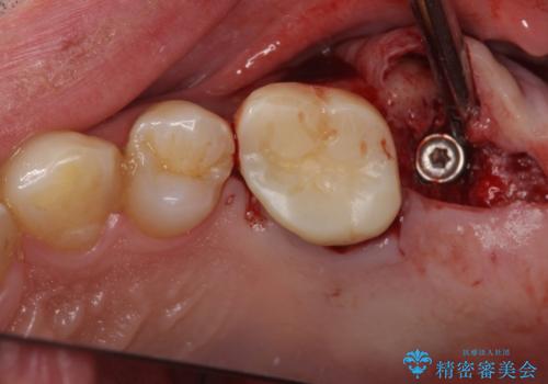 奥歯のむし歯が気になる 根管治療とインプラント治療の治療中