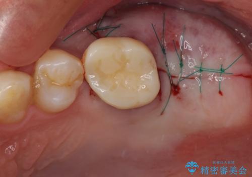 奥歯のむし歯が気になる 根管治療とインプラント治療の治療後