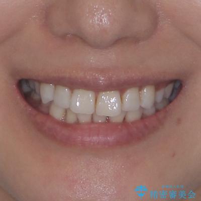 矯正治療の後戻り インビザラインで短期間矯正治療の治療前(顔貌)