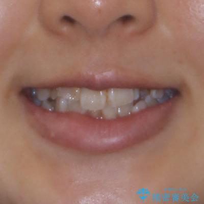 永久歯が埋もれて乳歯が残存 叢生改善のワイヤー抜歯矯正の治療前(顔貌)