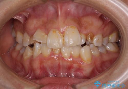 永久歯が埋もれて乳歯が残存 叢生改善のワイヤー抜歯矯正の症例 治療前