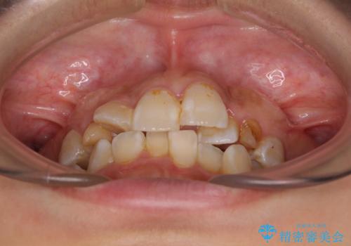 永久歯が埋もれて乳歯が残存 叢生改善のワイヤー抜歯矯正の治療前