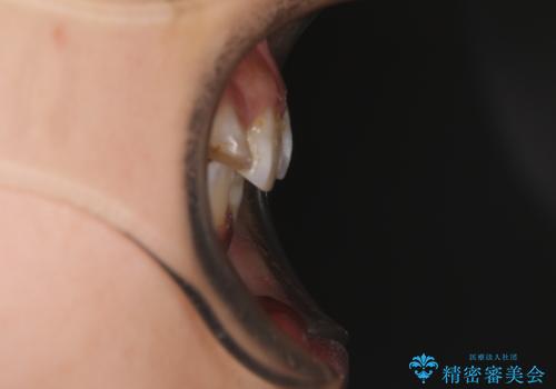 永久歯が埋もれて乳歯が残存 叢生改善のワイヤー抜歯矯正の治療前