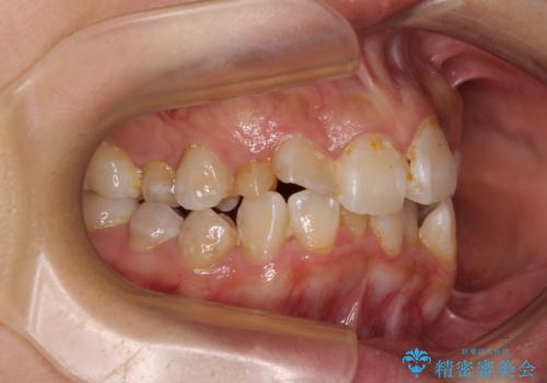 永久歯が埋もれて乳歯が残存 叢生改善のワイヤー抜歯矯正の治療前