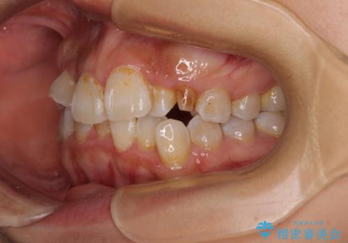 永久歯が埋もれて乳歯が残存 叢生改善のワイヤー抜歯矯正の治療前