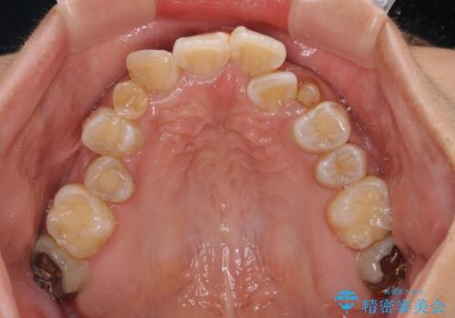 永久歯が埋もれて乳歯が残存 叢生改善のワイヤー抜歯矯正の治療前