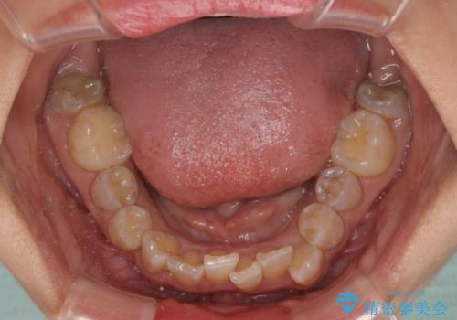 永久歯が埋もれて乳歯が残存 叢生改善のワイヤー抜歯矯正の治療前