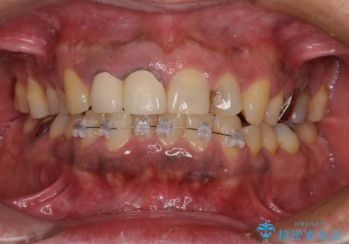 前歯の審美歯科治療 下顎の部分矯正と上顎前歯のオールセラミッククラウンの症例 治療前