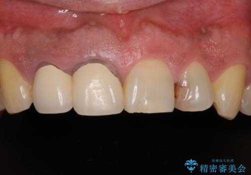 前歯の審美歯科治療 下顎の部分矯正と上顎前歯のオールセラミッククラウンの治療前