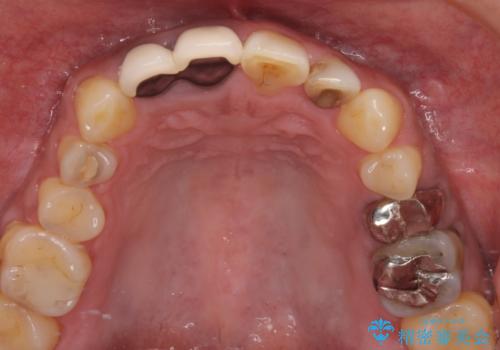 前歯の審美歯科治療 下顎の部分矯正と上顎前歯のオールセラミッククラウンの治療前