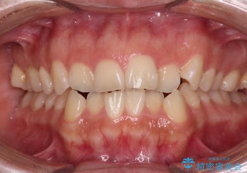 飛び出した前歯とデコボコ ワイヤー装置での抜歯矯正の症例 治療前