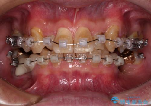 奥歯の欠損と前歯のデコボコを治したい インプラントと矯正治療の総合歯科治療の治療中
