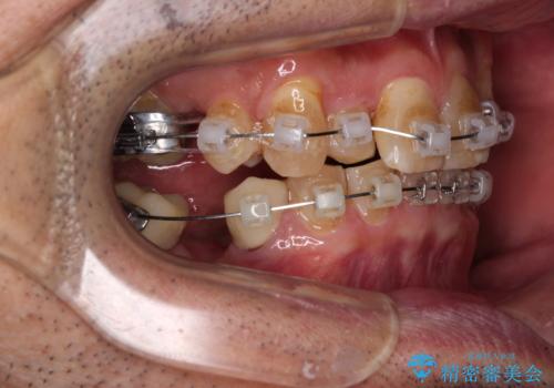 奥歯の欠損と前歯のデコボコを治したい インプラントと矯正治療の総合歯科治療の治療中