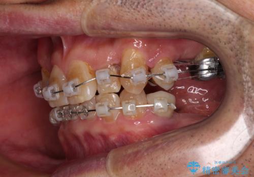 奥歯の欠損と前歯のデコボコを治したい インプラントと矯正治療の総合歯科治療の治療中