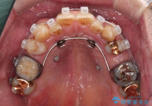 奥歯の欠損と前歯のデコボコを治したい インプラントと矯正治療の総合歯科治療の治療中