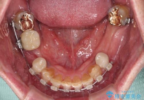 奥歯の欠損と前歯のデコボコを治したい インプラントと矯正治療の総合歯科治療の治療中