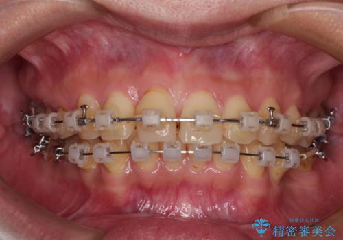 デコボコと乳歯の欠損 ワイヤー矯正とインプラント補綴治療の治療中