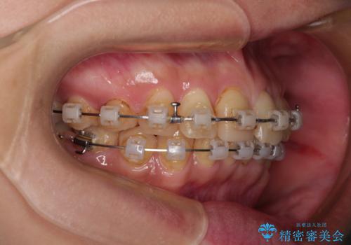 デコボコと乳歯の欠損 ワイヤー矯正とインプラント補綴治療の治療中