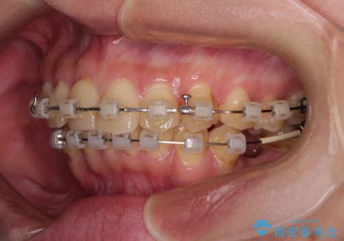 デコボコと乳歯の欠損 ワイヤー矯正とインプラント補綴治療の治療中