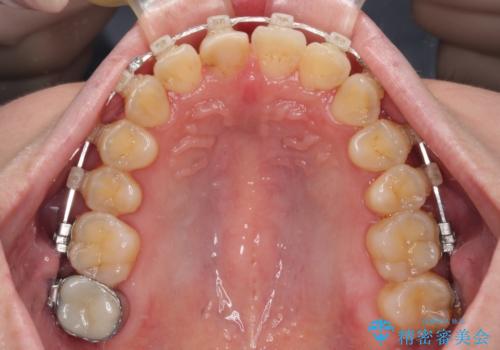 デコボコと乳歯の欠損 ワイヤー矯正とインプラント補綴治療の治療中