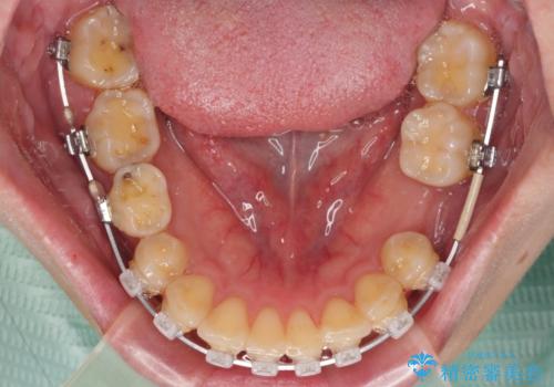 デコボコと乳歯の欠損 ワイヤー矯正とインプラント補綴治療の治療中