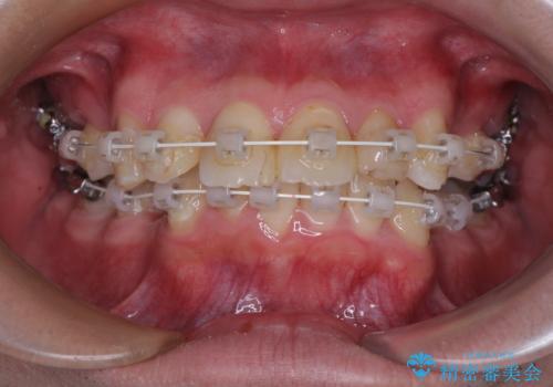 【モニター】出っ歯と奥歯の咬み合わせを改善 補助装置を用いたワイヤー抜歯矯正の治療中
