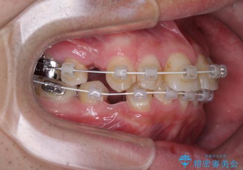 【モニター】出っ歯と奥歯の咬み合わせを改善 補助装置を用いたワイヤー抜歯矯正の治療中