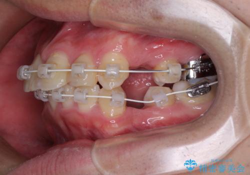 【モニター】出っ歯と奥歯の咬み合わせを改善 補助装置を用いたワイヤー抜歯矯正の治療中