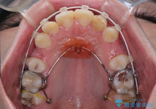【モニター】出っ歯と奥歯の咬み合わせを改善 補助装置を用いたワイヤー抜歯矯正の治療中