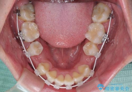 【モニター】出っ歯と奥歯の咬み合わせを改善 補助装置を用いたワイヤー抜歯矯正の治療中