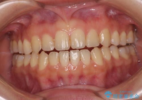 前歯のオープンバイト インビザラインで咬み合わせを改善の治療中