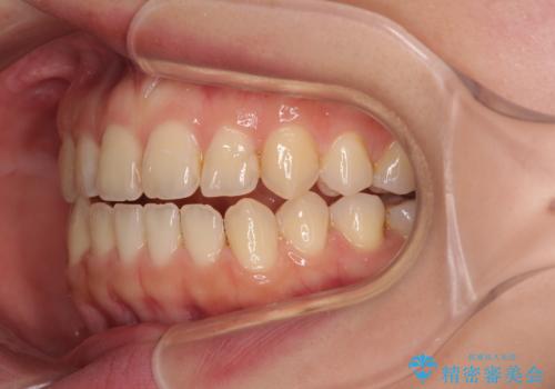 前歯のオープンバイト インビザラインで咬み合わせを改善の治療中