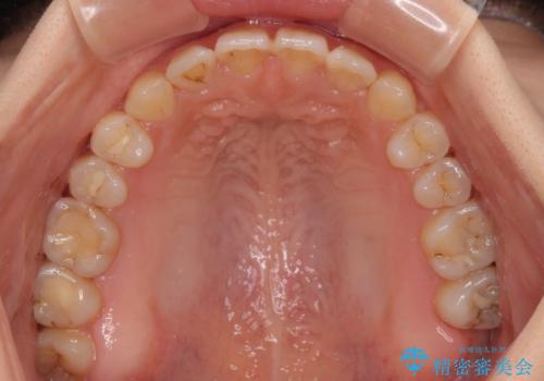 前歯のオープンバイト インビザラインで咬み合わせを改善の治療中