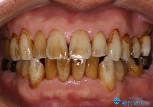 衝撃的なビフォーアフター!見違えるほど白い歯に!の症例 治療前