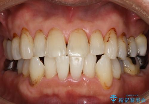 衝撃的なビフォーアフター!見違えるほど白い歯に!の症例 治療後