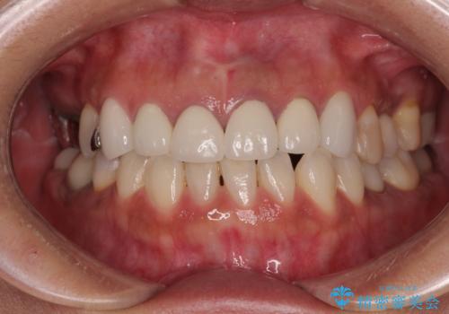 新幹線通院 地元で断られた奥歯のむし歯治療の症例 治療前