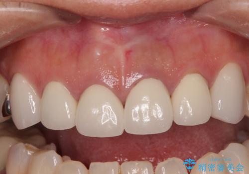 新幹線通院 地元で断られた奥歯のむし歯治療の治療前