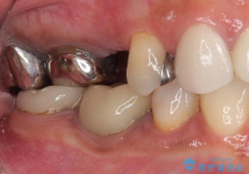 新幹線通院 地元で断られた奥歯のむし歯治療の治療前