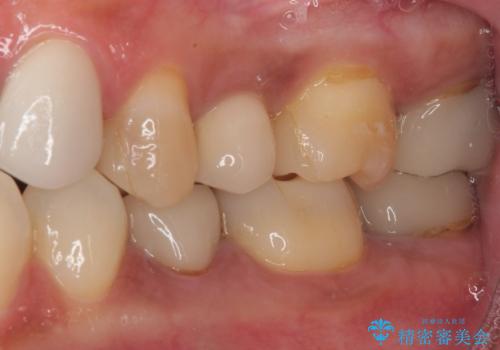 新幹線通院 地元で断られた奥歯のむし歯治療の治療前