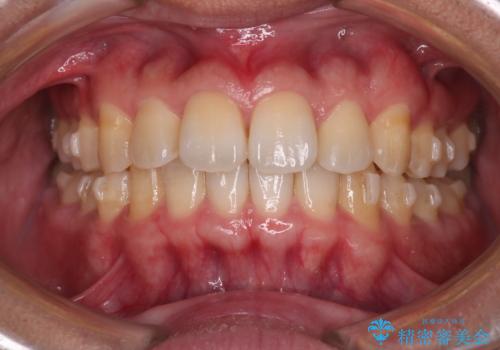 【インビザライン】目立たない矯正で前歯を綺麗にの治療中