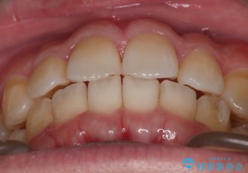 【インビザライン】目立たない矯正で前歯を綺麗にの治療中