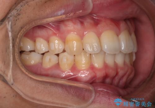 【インビザライン】目立たない矯正で前歯を綺麗にの治療中