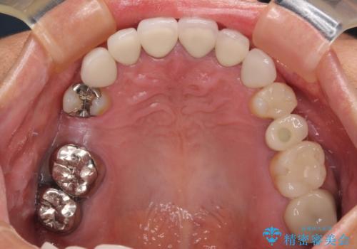 新幹線通院 地元で断られた奥歯のむし歯治療の治療前